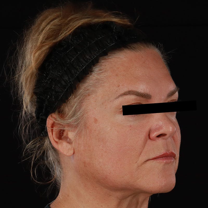 Morpheus8 Before & After Gallery - Patient 110627 - Image 3
