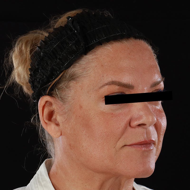 Morpheus8 Before & After Gallery - Patient 110627 - Image 4