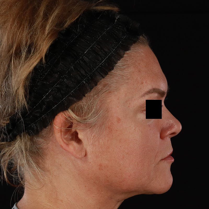 Morpheus8 Before & After Gallery - Patient 110627 - Image 5