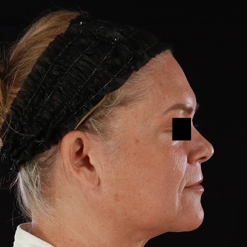 Morpheus8 Before & After Gallery - Patient 110627 - Image 6