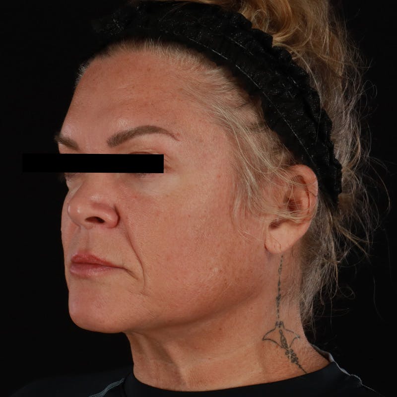 Morpheus8 Before & After Gallery - Patient 110627 - Image 7
