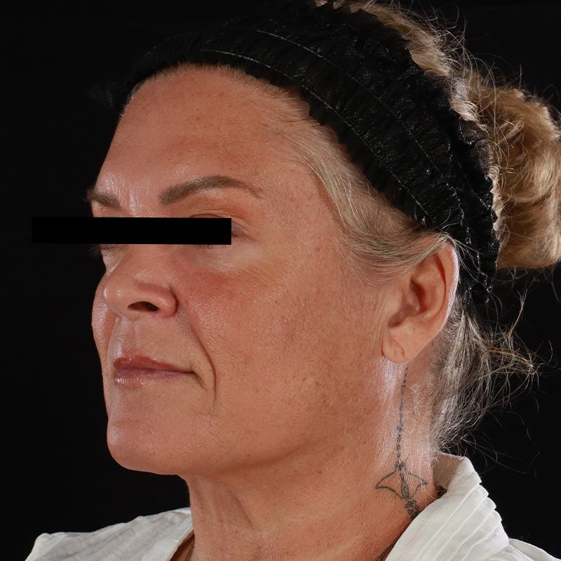 Morpheus8 Before & After Gallery - Patient 110627 - Image 8
