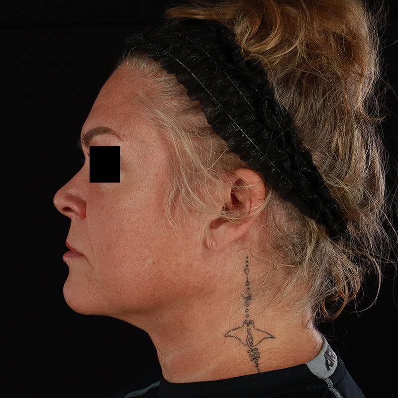 Morpheus8 Before & After Gallery - Patient 110627 - Image 9