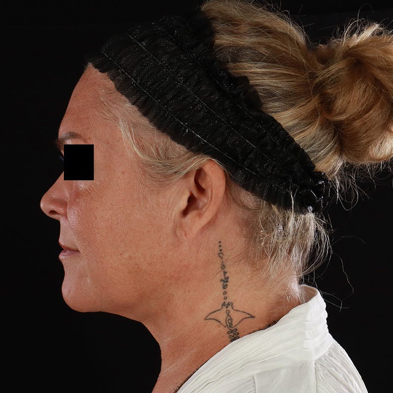 Morpheus8 Before & After Gallery - Patient 110627 - Image 10