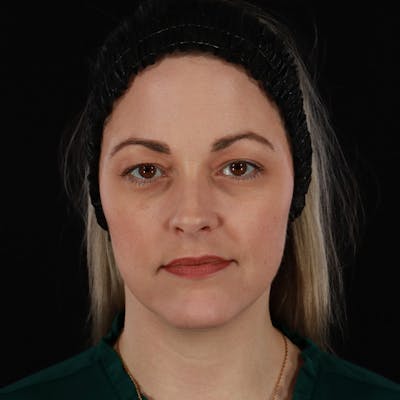 Sculptra Before & After Gallery - Patient 416882 - Image 1