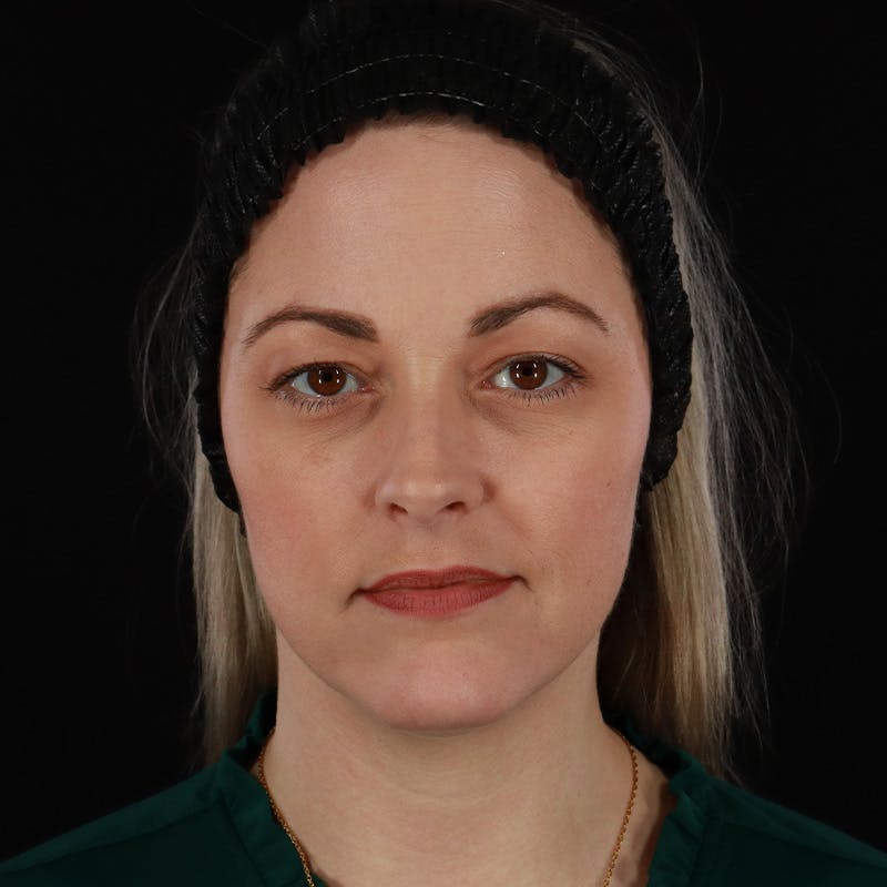 Sculptra Before & After Gallery - Patient 416882 - Image 1