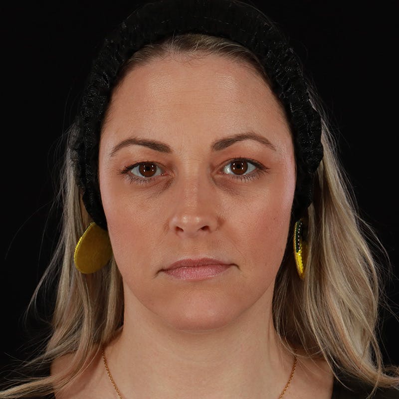 Sculptra Before & After Gallery - Patient 416882 - Image 2