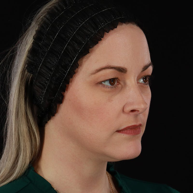 Sculptra Before & After Gallery - Patient 416882 - Image 3