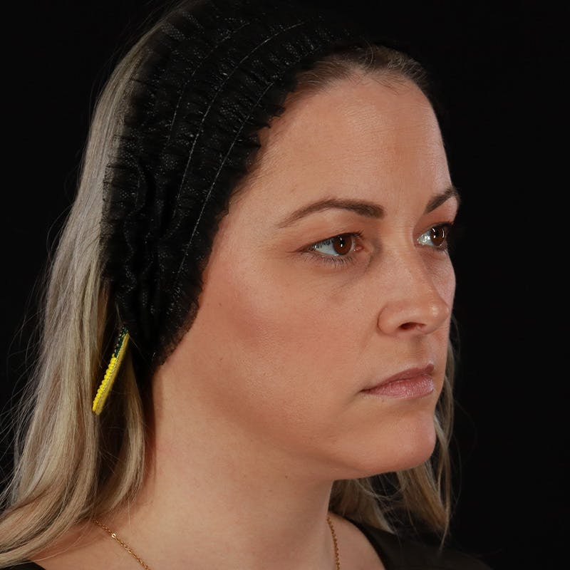 Sculptra Before & After Gallery - Patient 416882 - Image 4