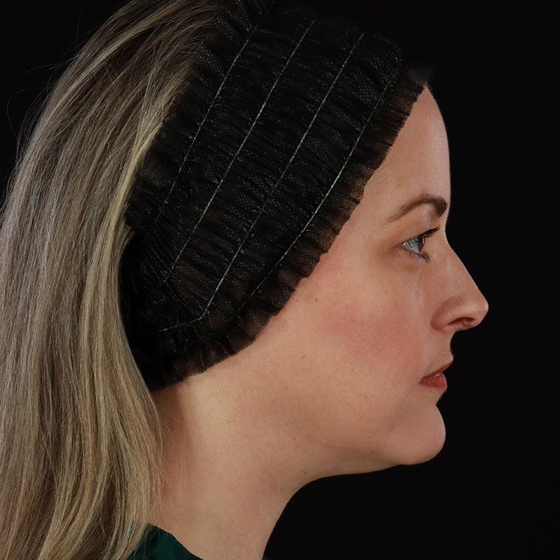 Sculptra Before & After Gallery - Patient 416882 - Image 5