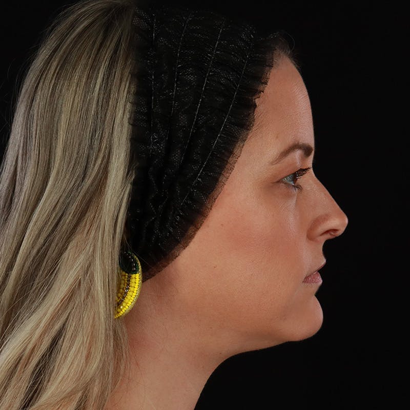 Sculptra Before & After Gallery - Patient 416882 - Image 6
