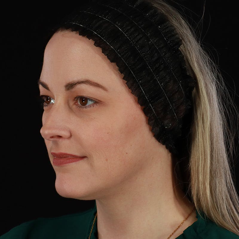 Sculptra Before & After Gallery - Patient 416882 - Image 7