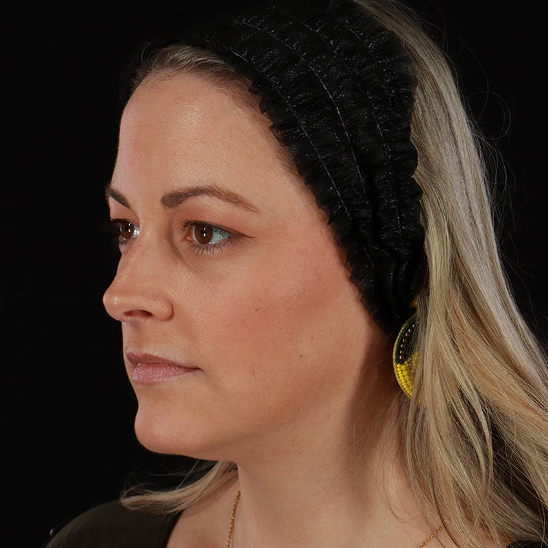 Sculptra Before & After Gallery - Patient 416882 - Image 8