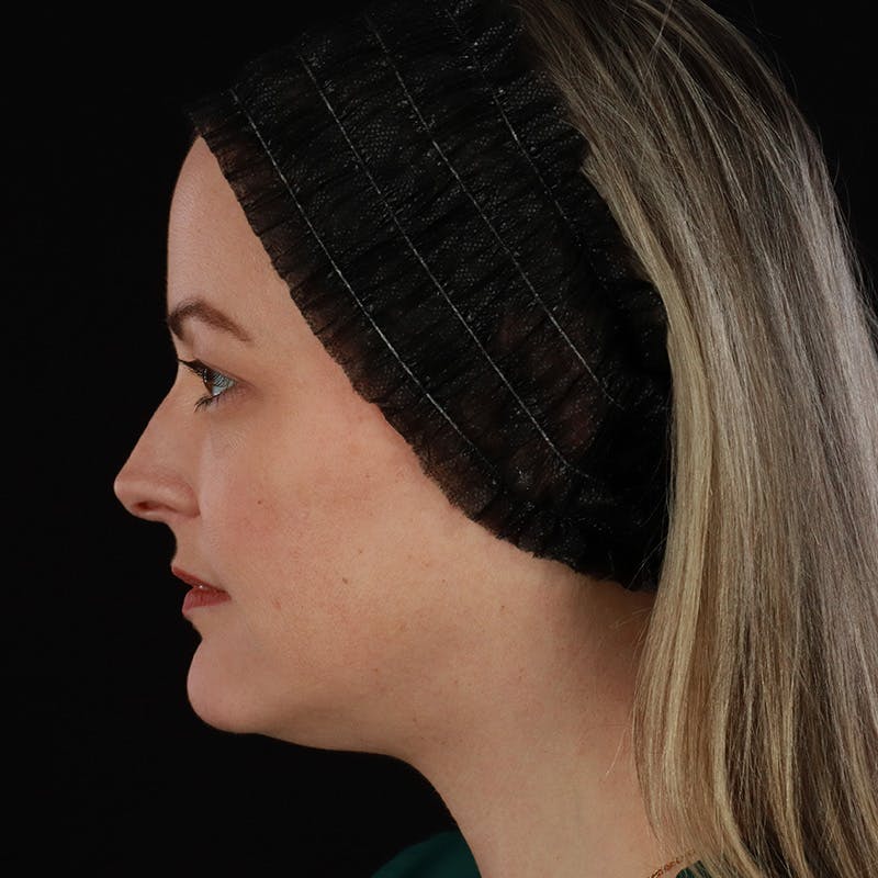 Sculptra Before & After Gallery - Patient 416882 - Image 9