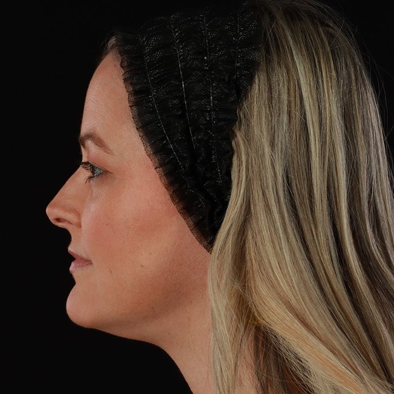 Sculptra Before & After Gallery - Patient 416882 - Image 10