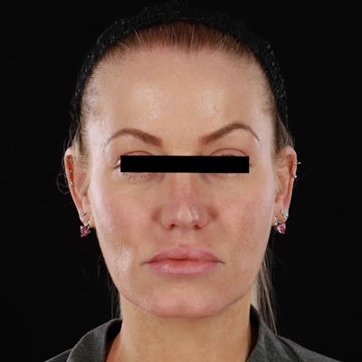 PRP/PRF Therapy Before & After Gallery - Patient 265661 - Image 1