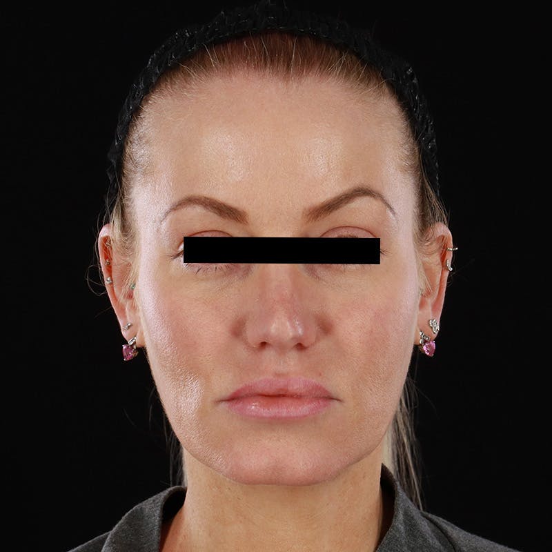 PRP/PRF Therapy Before & After Gallery - Patient 265661 - Image 1