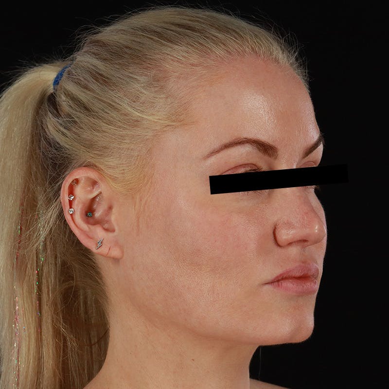 PRP/PRF Therapy Before & After Gallery - Patient 265661 - Image 4