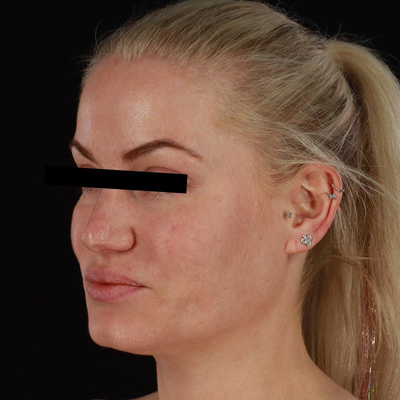 PRP/PRF Therapy Before & After Gallery - Patient 265661 - Image 6