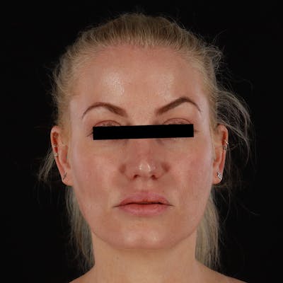 PRP/PRF Therapy Before & After Gallery - Patient 265661 - Image 2