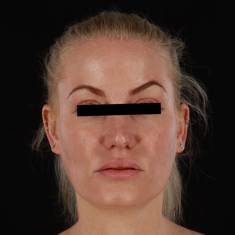 PRP/PRF Therapy Before & After Gallery - Patient 265661 - Image 2