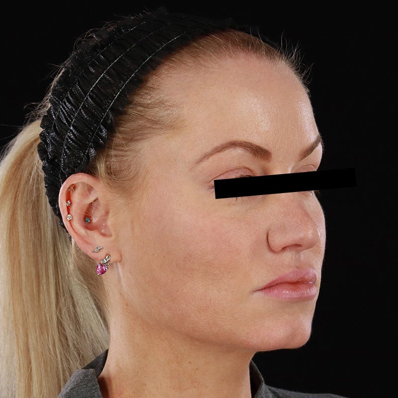 PRP/PRF Therapy Before & After Gallery - Patient 265661 - Image 3