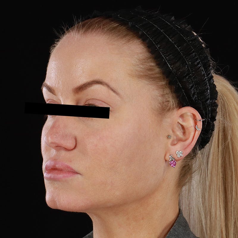 PRP/PRF Therapy Before & After Gallery - Patient 265661 - Image 5