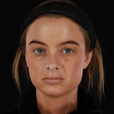 Microneedling Before & After Gallery - Patient 409850 - Image 1