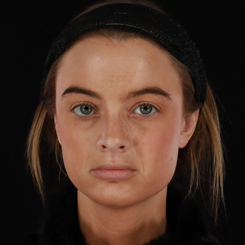 Microneedling Before & After Gallery - Patient 409850 - Image 1