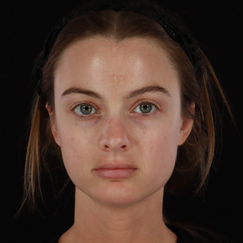Microneedling Before & After Gallery - Patient 409850 - Image 2
