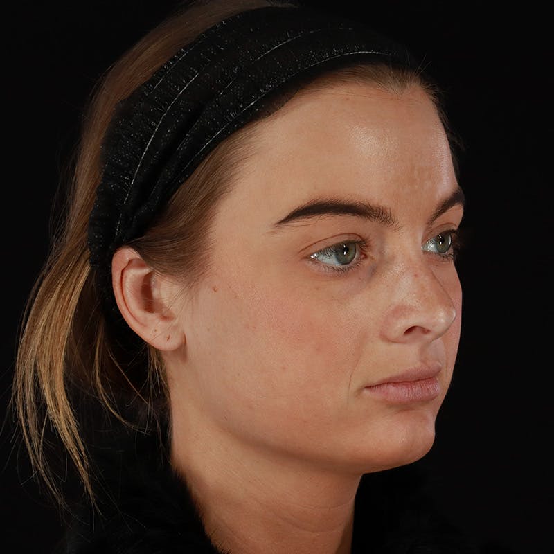 Microneedling Before & After Gallery - Patient 409850 - Image 3