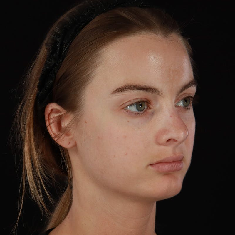 Microneedling Before & After Gallery - Patient 409850 - Image 4