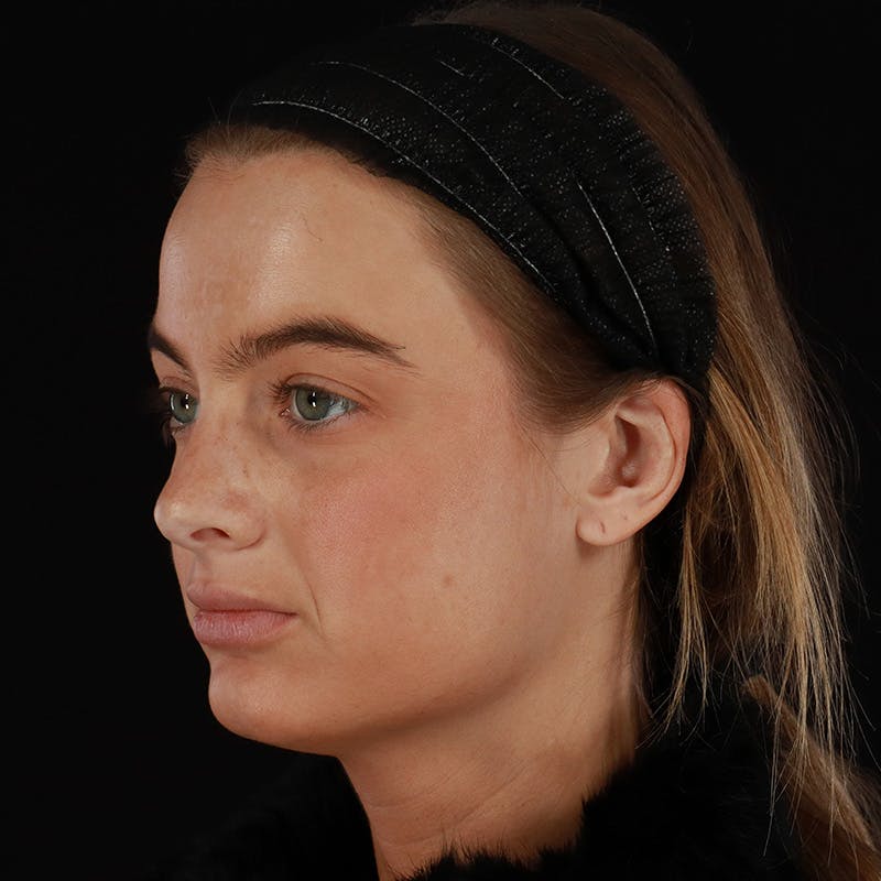 Microneedling Before & After Gallery - Patient 409850 - Image 5