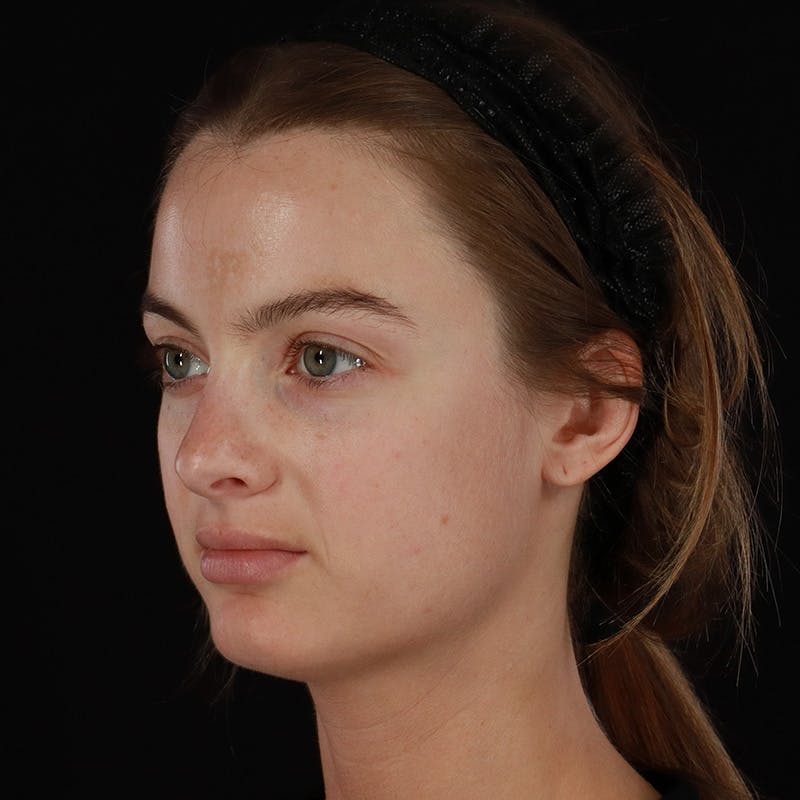 Microneedling Before & After Gallery - Patient 409850 - Image 6