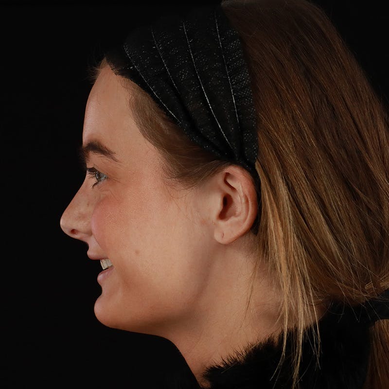 Microneedling Before & After Gallery - Patient 409850 - Image 7