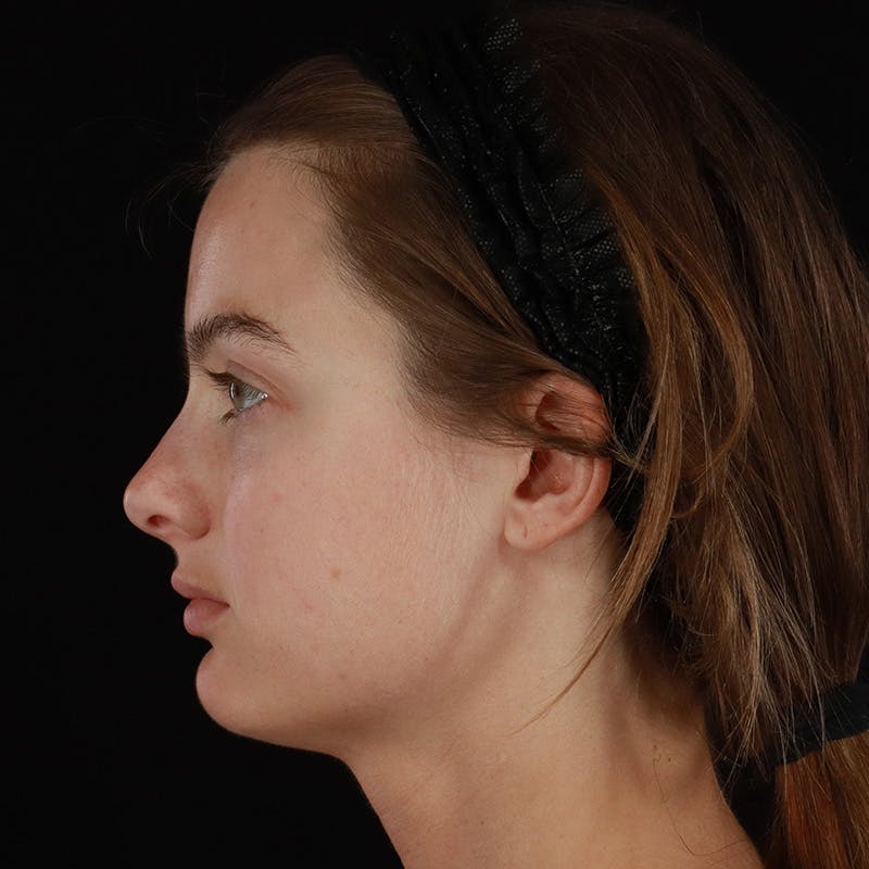 Microneedling Before & After Gallery - Patient 409850 - Image 8