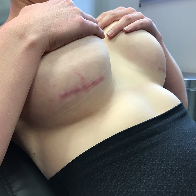 Microneedling Before & After Gallery - Patient 413564 - Image 3