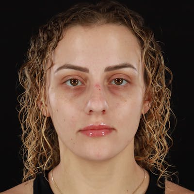 Microneedling Before & After Gallery - Patient 180664 - Image 1