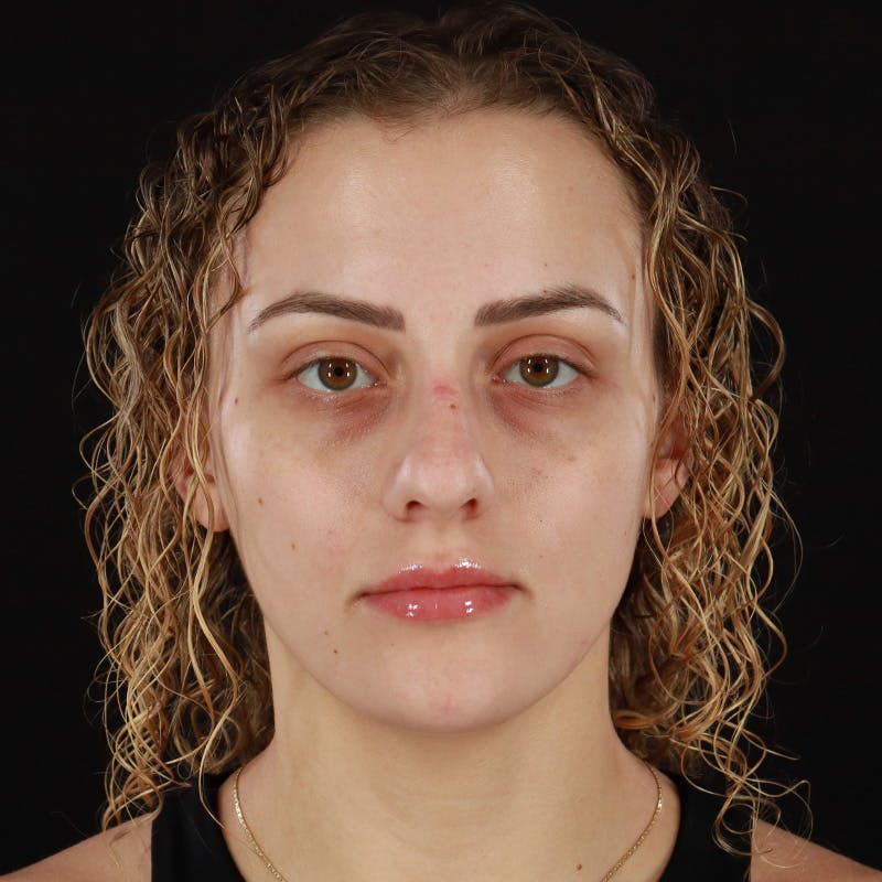 Microneedling Before & After Gallery - Patient 180664 - Image 1