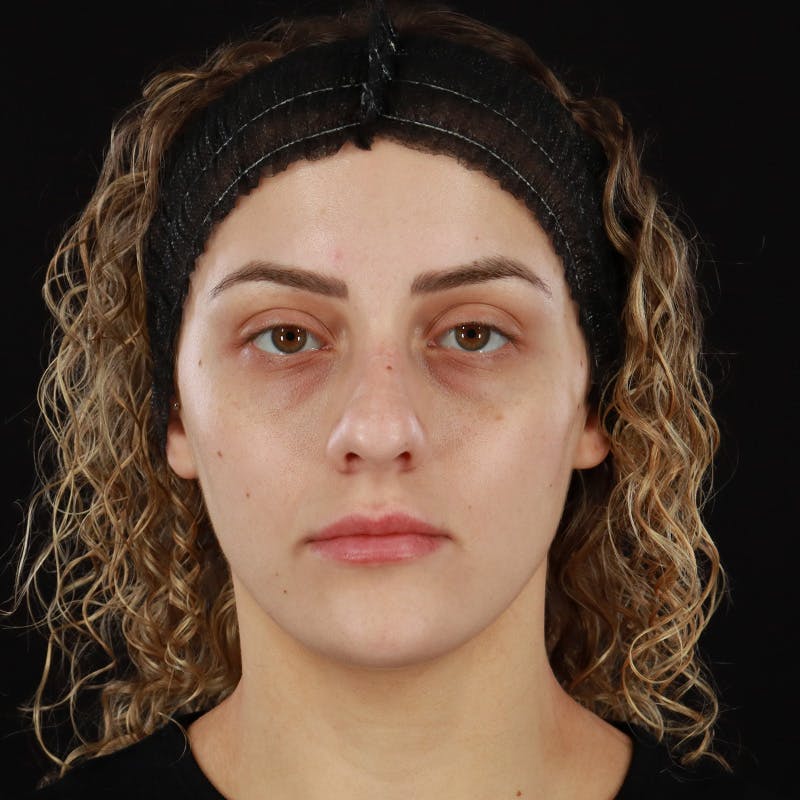 Microneedling Before & After Gallery - Patient 180664 - Image 2