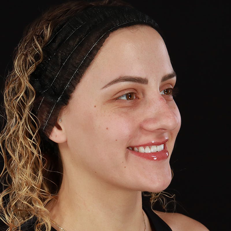 Microneedling Before & After Gallery - Patient 180664 - Image 3