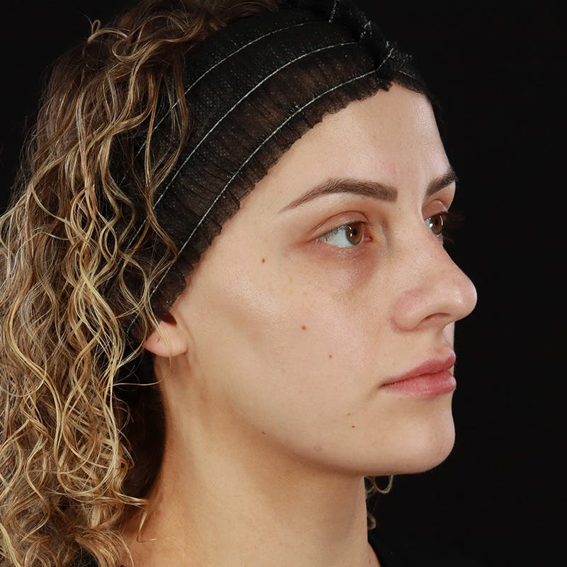 Microneedling Before & After Gallery - Patient 180664 - Image 4