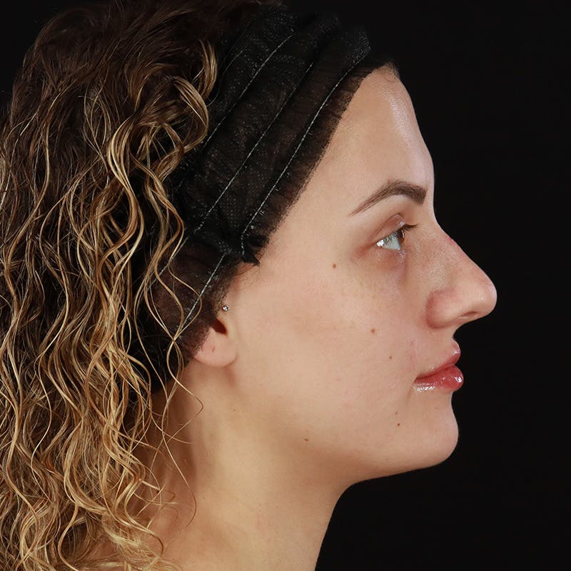 Microneedling Before & After Gallery - Patient 180664 - Image 5