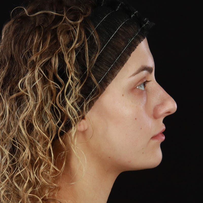 Microneedling Before & After Gallery - Patient 180664 - Image 6
