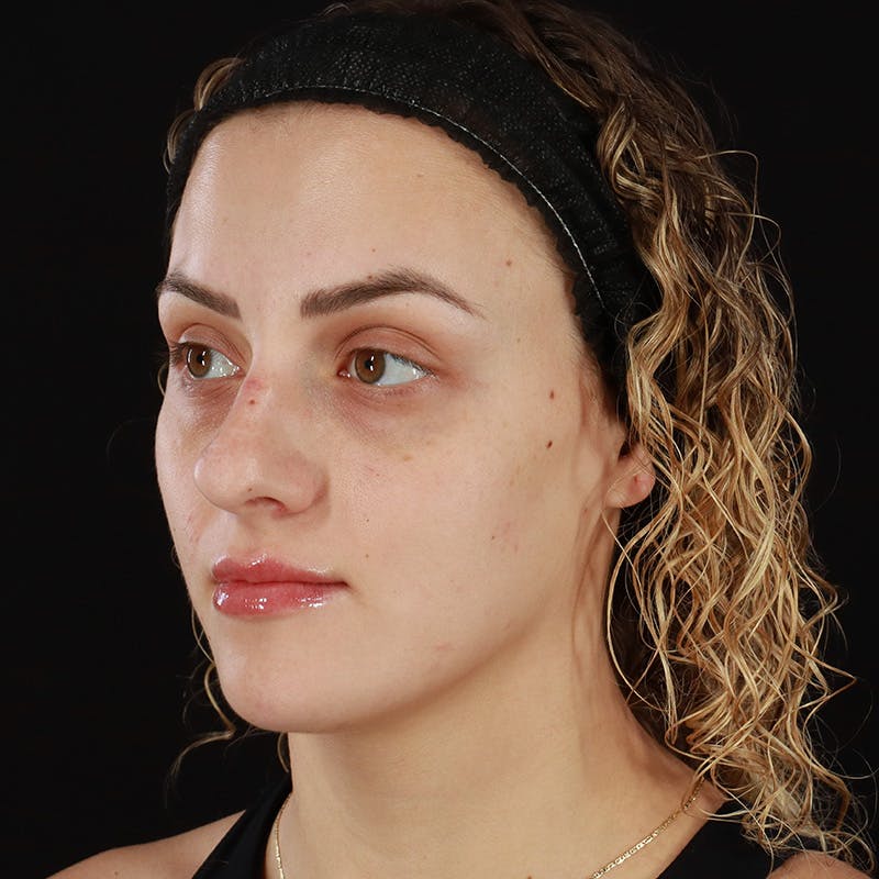 Microneedling Before & After Gallery - Patient 180664 - Image 7
