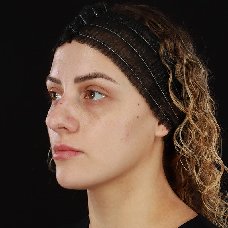Microneedling Before & After Gallery - Patient 180664 - Image 8