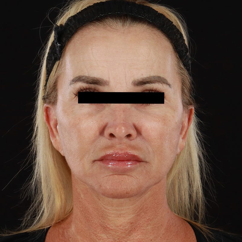 Microneedling Before & After Gallery - Patient 273381 - Image 1