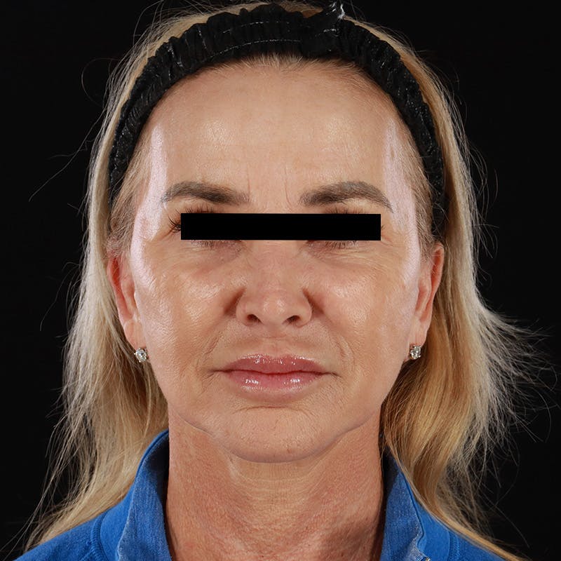 Microneedling Before & After Gallery - Patient 273381 - Image 2