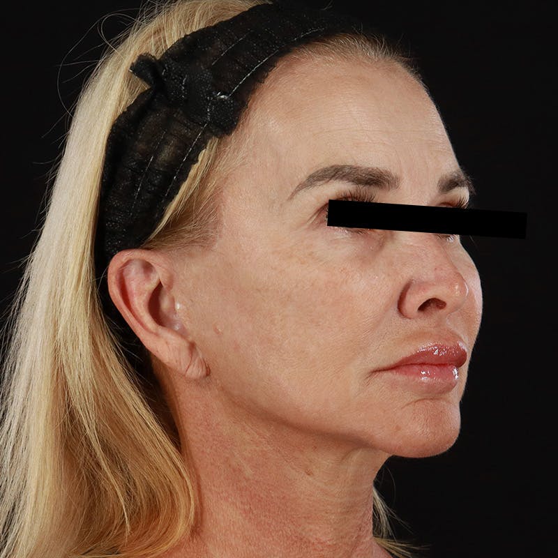 Microneedling Before & After Gallery - Patient 273381 - Image 3