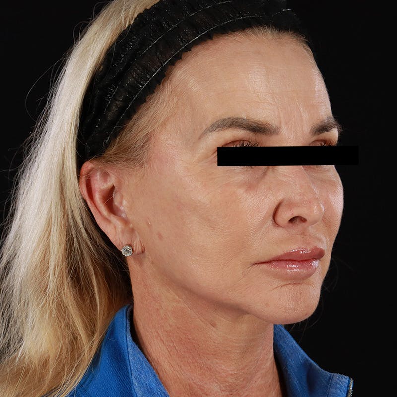 Microneedling Before & After Gallery - Patient 273381 - Image 4